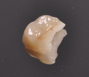 Onlay en céramique