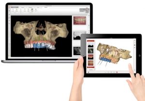 Planification implantaire en 3D sur écran