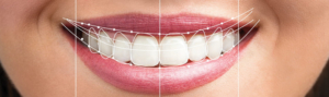 Digital Smile Design : tracé du sourire